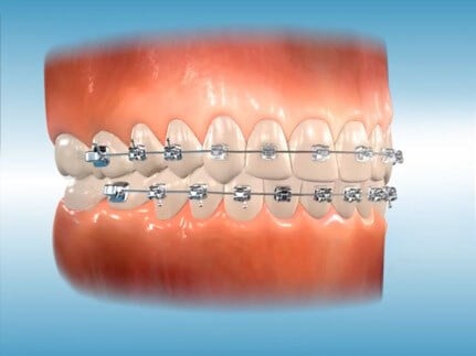Braces