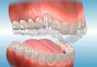 Invisalign® Aligners