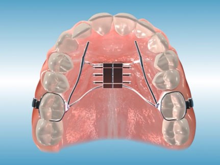 Rapid Palatal Expander (RPE)