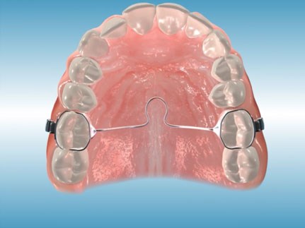 Transpalantal Bar