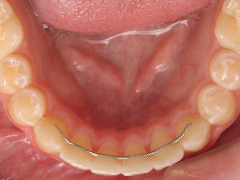 Fixed Retainers